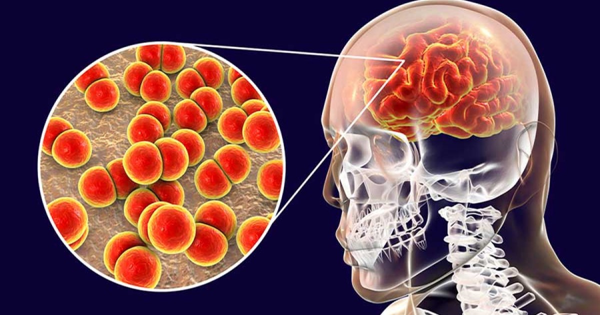 Qué es la meningitis, cuáles son sus síntomas y cómo tratarla Omnia