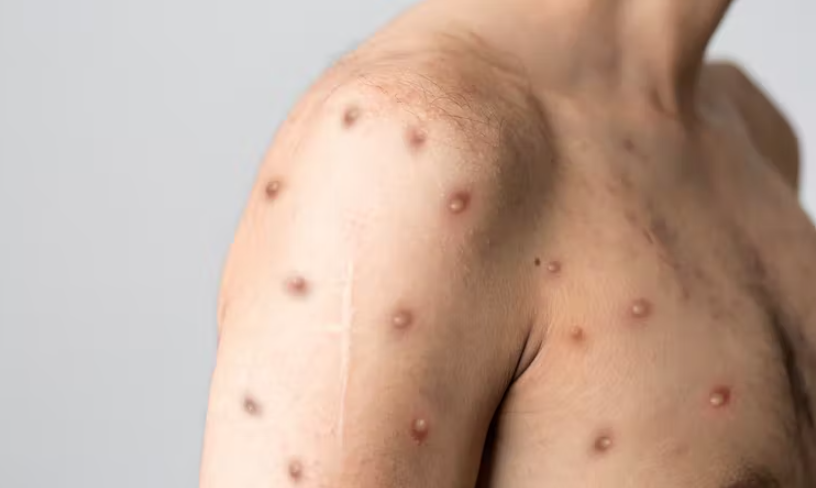 Is the monkeypox vaccine for everybody?  This suggests a expert