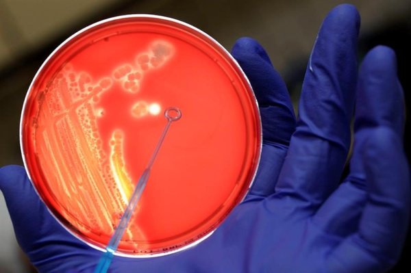 Detección temprana y tratamiento dirigido, ante brote de bacteria Klebsiella oxytoca