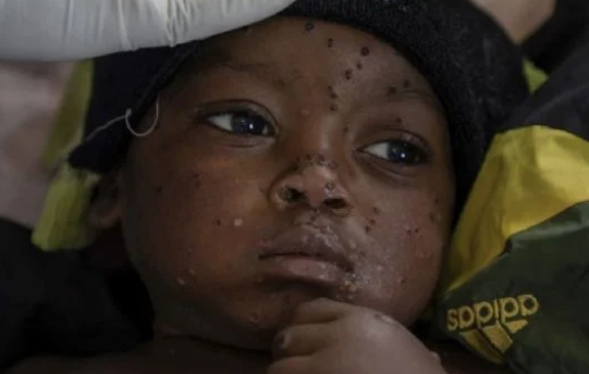 OMS dice que casos de viruela símica (mpox) en el Congo se están 