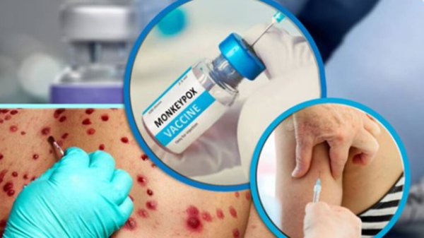 Francia confirma primer caso de nueva variante de Mpox